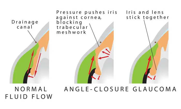 Angel Closure Glaucoma