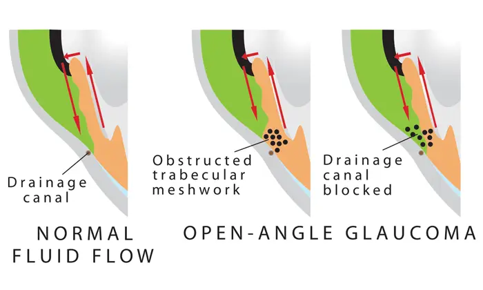 Angel Closure Glaucoma