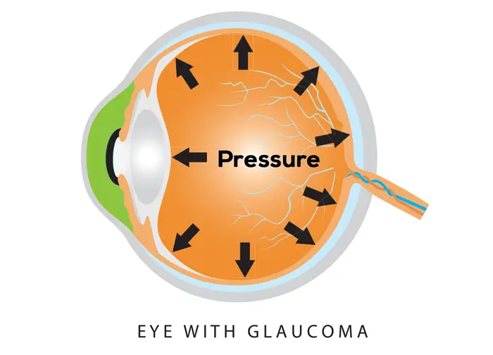 Eye With Glaucoma