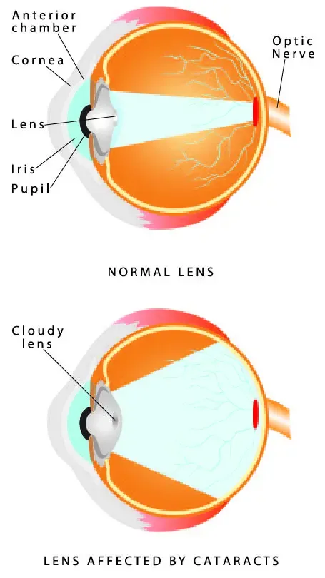 cataract