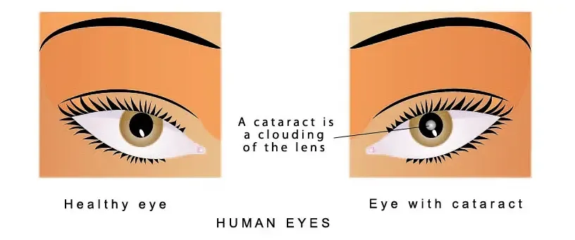 cataract