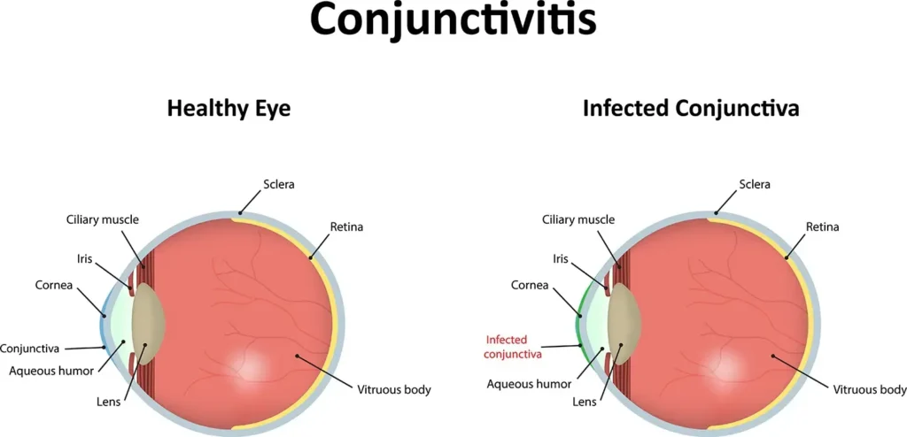 conjunctivitis