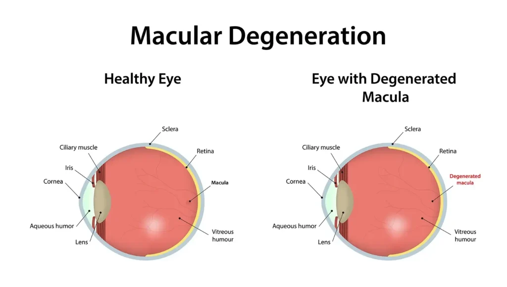 macular degeneration